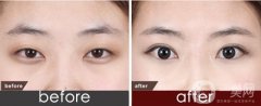 *全切雙眼皮真的能做到自然*嗎?