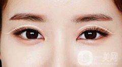 割雙眼皮過程大概需要多長時(shí)間?