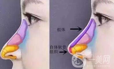 北京整容墊鼻梁多少錢(qián)？附隆鼻價(jià)格明細(xì)一覽表
