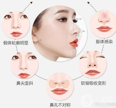 隆鼻修復(fù)手術(shù)價(jià)格多少錢(qián)?什么原因會(huì)影響價(jià)格?