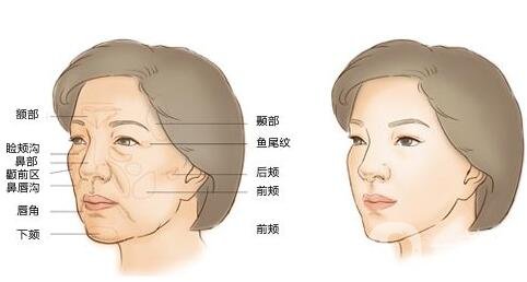 面部脂肪填充吃什么成活率高？