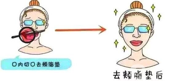 去頰脂墊價格貴嗎?要多少錢?