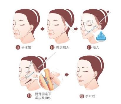 下筋膜懸吊祛皺術(shù)怎么操作的？*果嗎？