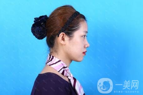 玻尿酸豐面頰