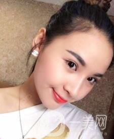 玻尿酸豐面頰