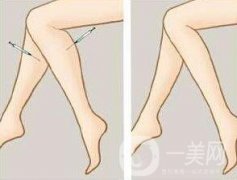 注射瘦臉瘦小腿一般多少錢？