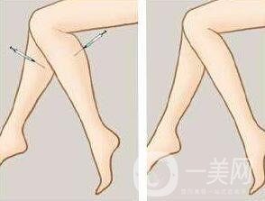 *瘦小腿一般多少錢(qián)？