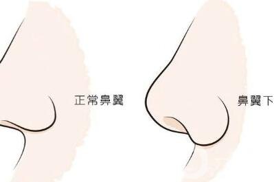 鼻翼缺損矯正*大嗎？要多少錢？