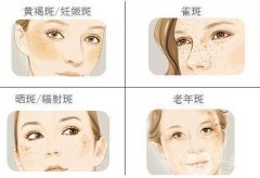 激光祛斑果怎么樣?會(huì)復(fù)發(fā)嗎?