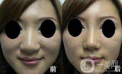 鼻頭縮小手術