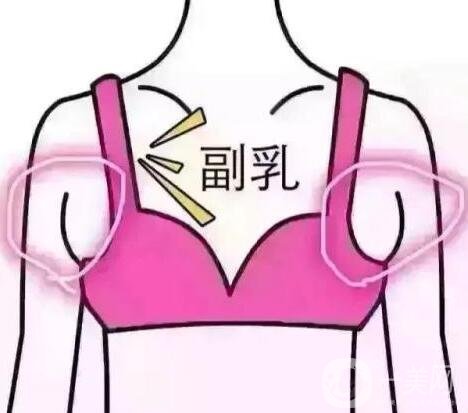 腋下副乳手術(shù)的價格是多少?影響因素有哪些呢?