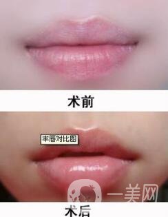 玻尿酸豐唇