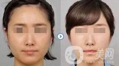 打*臉會(huì)腫嗎？恢復(fù)期要多久？