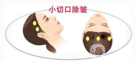 小切口除皺術(shù)后恢復(fù)過程是怎樣的？