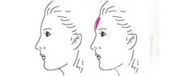 額部填充術(shù)的常見方法有哪些?