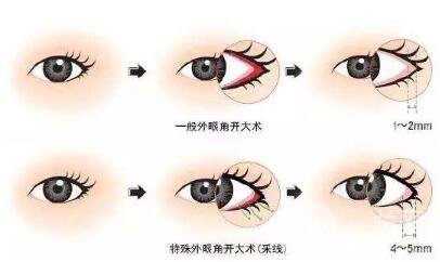 開外眼角會留疤嗎？留疤了怎么辦？