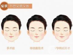 下頜角手術(shù)術(shù)后護(hù)理要注意哪些？