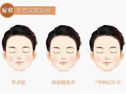 下頜角手術(shù)術(shù)后護(hù)理要注意哪些？