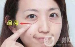 玻尿酸豐淚溝有危險(xiǎn)嗎？能管多久？