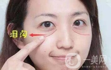 玻尿酸豐淚溝有危險(xiǎn)嗎？能管多久？