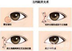 開(kāi)內(nèi)眼角后遺癥有哪些?術(shù)后需要如何護(hù)理?