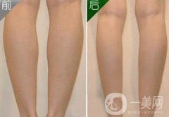 神經(jīng)瘦小腿是*的嗎?