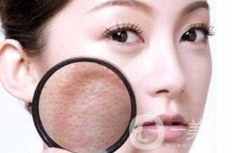 收縮毛孔