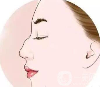 駝峰鼻矯正價錢貴嗎?大概是多少?