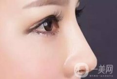 注射隆鼻失敗了怎么辦?如何修復(fù)?