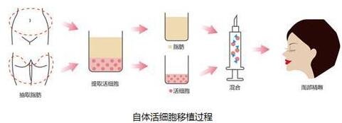 自身脂肪填充面部多久恢復(fù)?手術(shù)之后要注意?