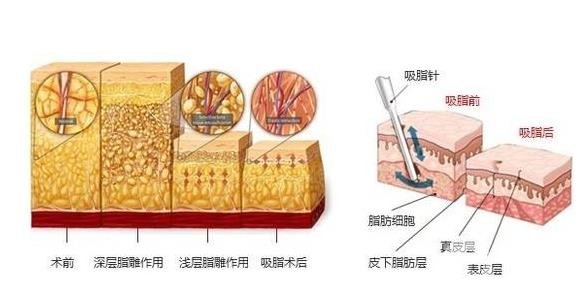 360度吸脂的手術(shù)需要多少錢？