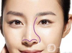 鼻尖成形術(shù)術(shù)后注意事項(xiàng)盤點(diǎn)