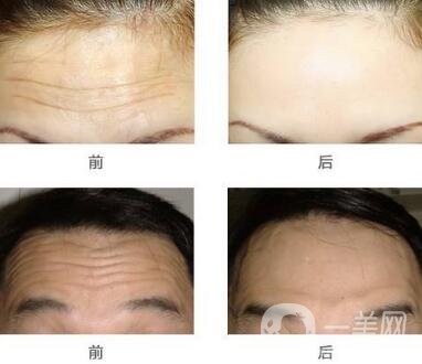 抬頭紋手術(shù)價(jià)格
