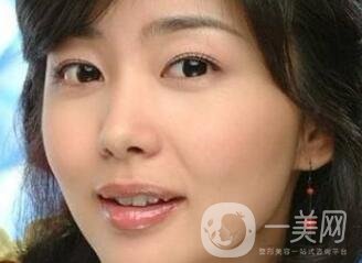 駝峰鼻矯正