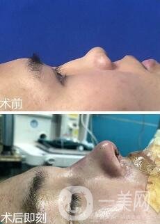 駝峰鼻矯正