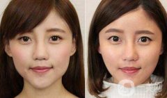 *要打幾次才可以定型?