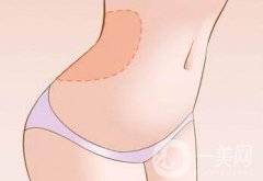 腹壁整形多少錢？費用詳細解說