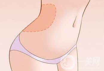 腹壁整形多少錢？費用詳細解說