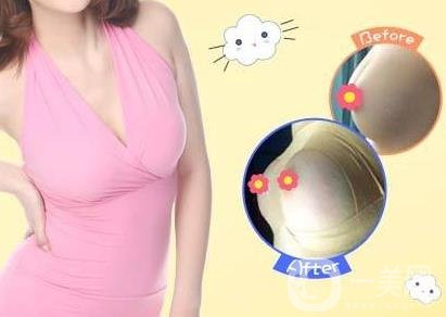 娜高豐胸假體好不好？需要多少錢？