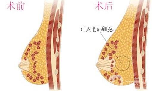 自體細(xì)胞豐胸*果自然嗎？要恢復(fù)多久？