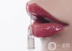 玻尿酸豐唇珠能夠保持多久？需要繼續(xù)注射嗎？