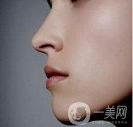 骨粉隆鼻后遺癥是什么樣的？