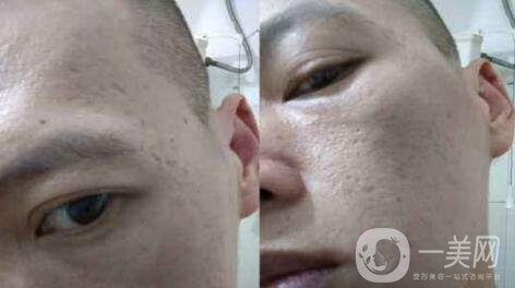 自體細(xì)胞注射去痘坑