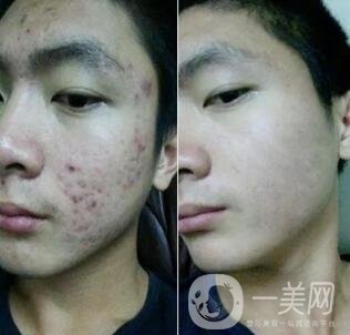 自體細(xì)胞注射去痘坑