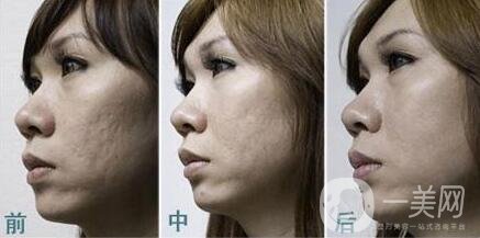 自體細(xì)胞注射去痘坑