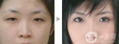 做雙眼皮手術(shù)*嗎?術(shù)前注意事項(xiàng)盤(pán)點(diǎn)