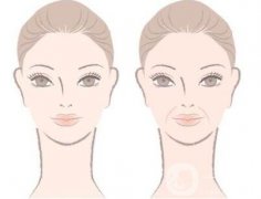 注射豐鼻唇溝果明X嗎？能立馬*果嗎？