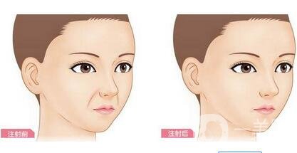 注射豐鼻唇溝*果*嗎？能立馬*果嗎？