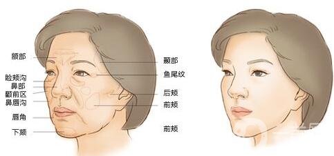 注射豐鼻唇溝*果*嗎？能立馬*果嗎？
