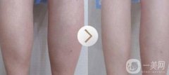 注射瘦腿有用嗎?會不會有后遺癥出現(xiàn)?